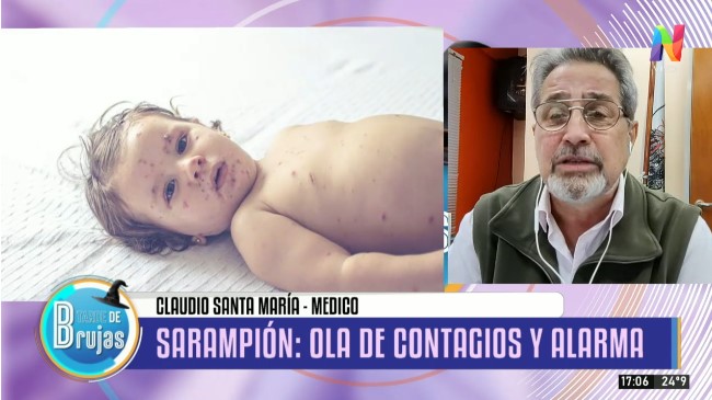 Alerta sanitaria: El Ministerio de Salud confirmó una nueva ola de sarampión en Argentina
